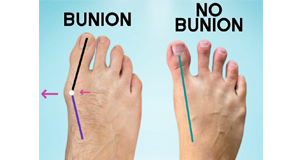 Bunions