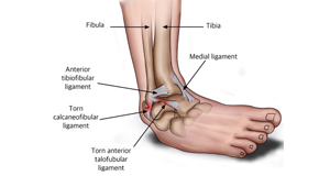 Ligament and tendon tears