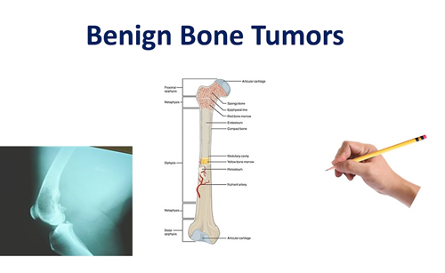 Bone Tumors