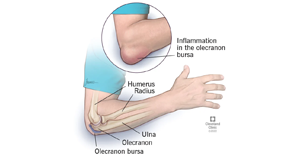 Bursitis