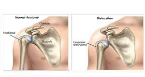 Shoulder Dislocation