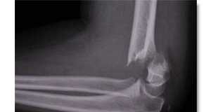 Elbow fracture