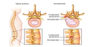 Slipped disk