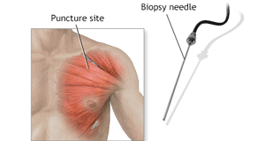 Muscle-Biopsy