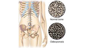 Osteoporosis