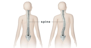 Scoliosis