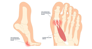 Sesamoiditis