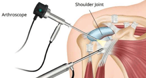 Shoulder arthroscopy