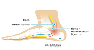 tarsal tunnel syndrome