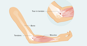 Tendinitis of Hand and Wrist