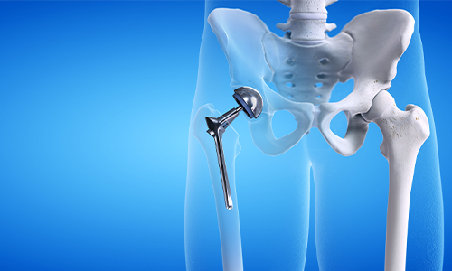 Total Hip Replacement