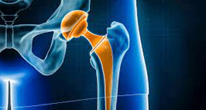 joint replacement