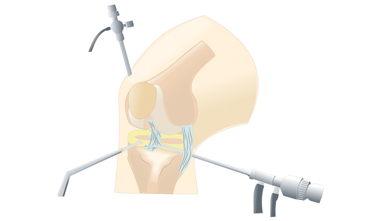 Knee preservation