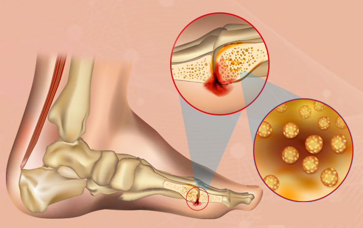 Osteomyelitis